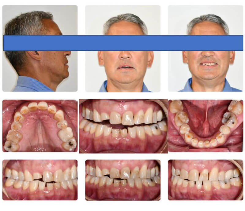 Initial facial and intraoral images prior to treatment showing jaw position and occlusion
