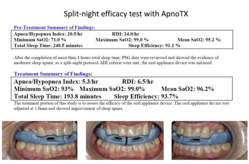 Split-night sleep study results demonstrating improvement in apnea-hypopnea index with ApnoTX therapy