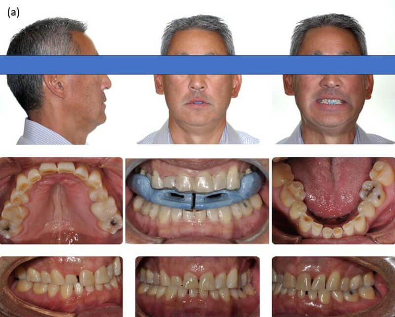 Initial intraoral and extraoral photographs showing patient wearing older ApnoTX design with upper and lower clear retainers