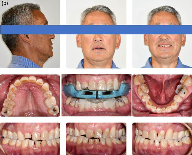 Post-teledontic intraoral and extraoral photographs showing provisional restorations and ApnoTX appliance over Vivera retainers