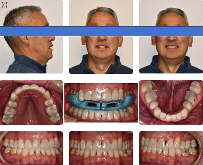 Post-teledontic intraoral and extraoral photographs showing final restorations with ApnoTX appliance over Vivera retainers