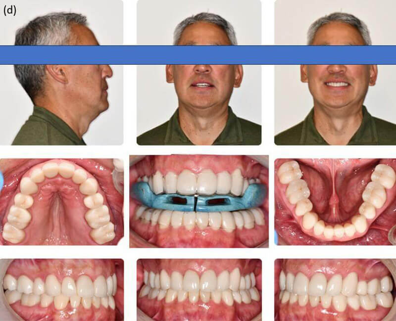 Final intraoral and extraoral photographs showing stable occlusion and completed restorations with ApnoTX appliance over Vivera retainers