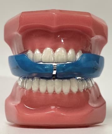 ApnoDent hybrid mandibular advancement device positioned in jaw model