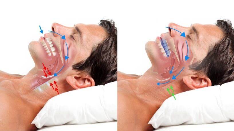 Comparison showing airway restriction versus improved airway flow with mandibular advancement