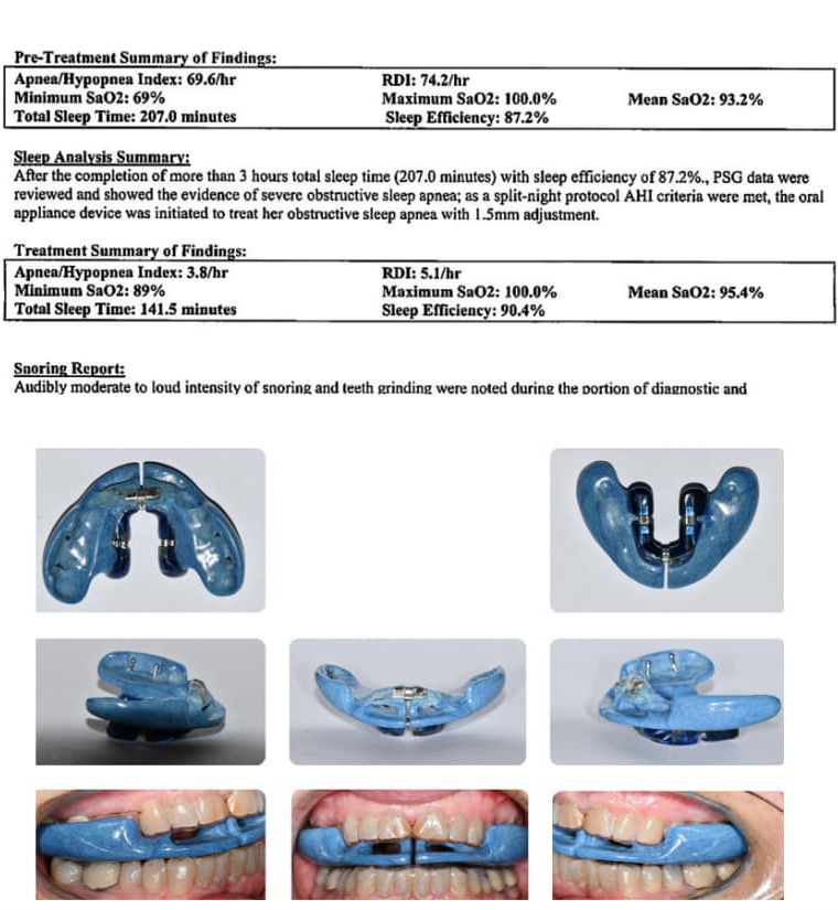 Polysomnography report showing improvement in AHI after ApnoDent therapy