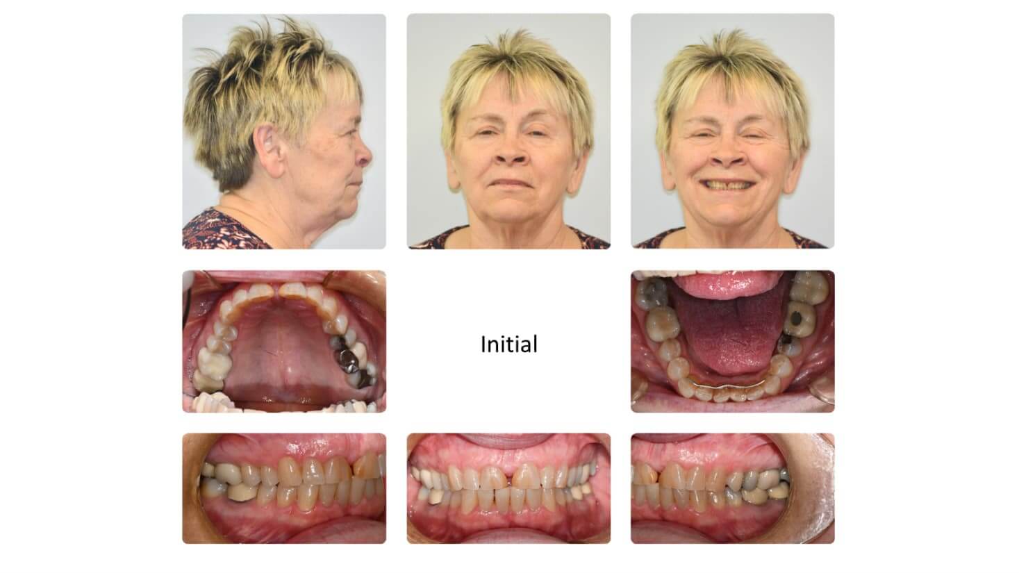 Before and after case showing facial and dental changes with ApnoTx therapy