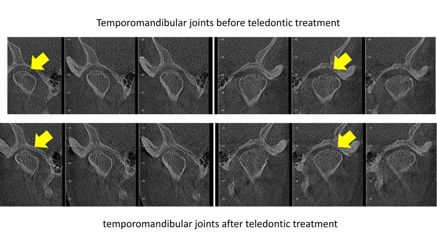 CBCT images of temporomandibular joints before and after teledontic treatment showing structural improvement