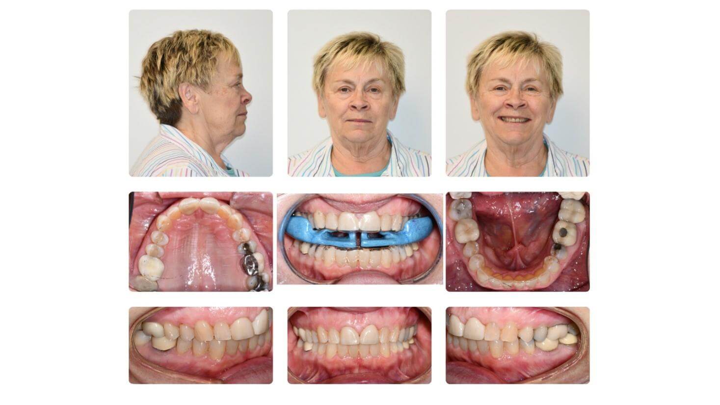 One year post-treatment case showing ApnoTx fitting over Vivera retainers with facial and dental results