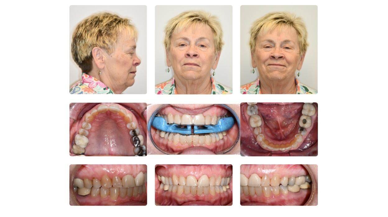 Three year post-treatment case showing ApnoTX fitting over Vivera retainers with stable facial and dental results